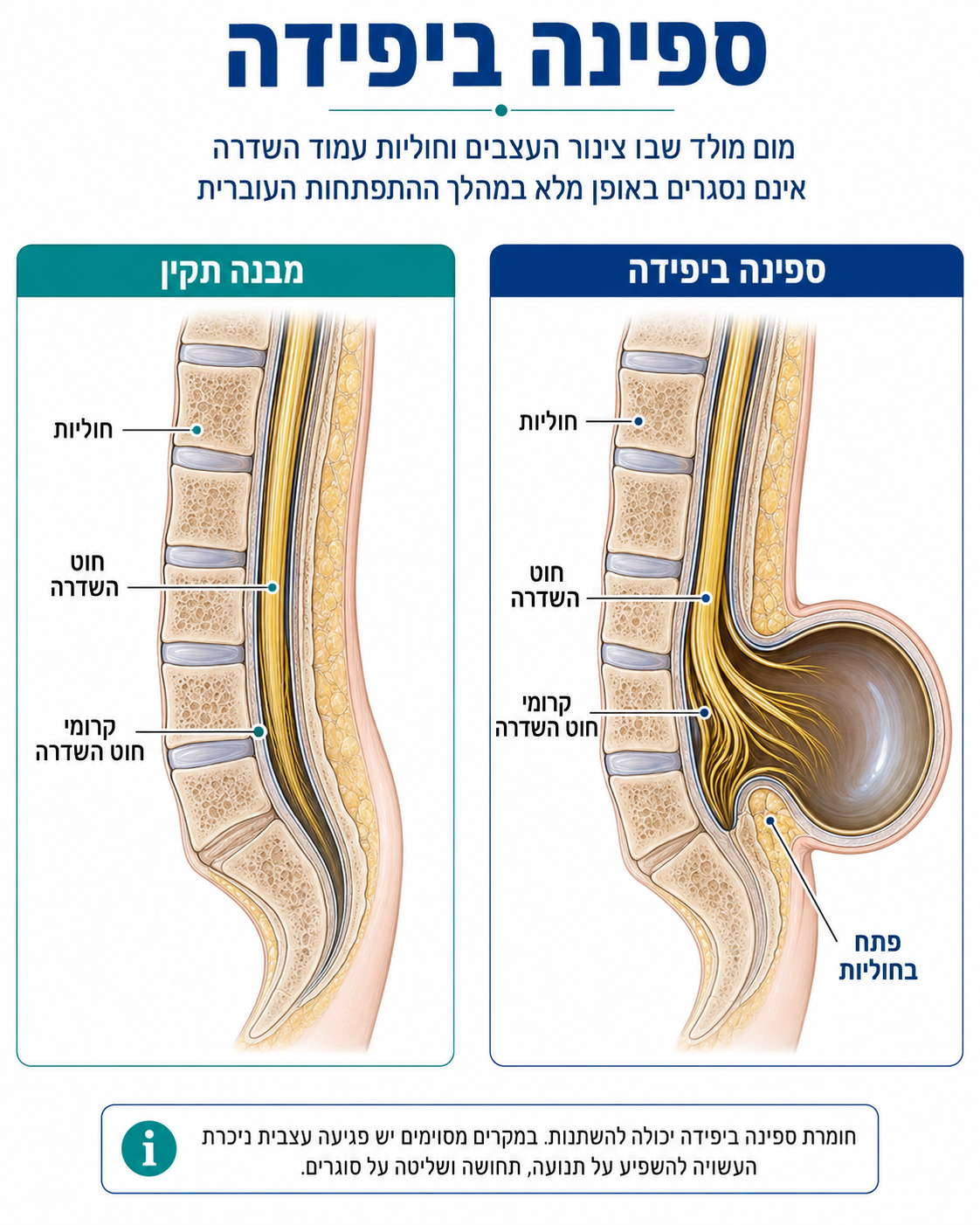 ספינה ביפידה, כף הרגל וההליכה: מה חשוב לדעת לפני שבוחרים נעליים?